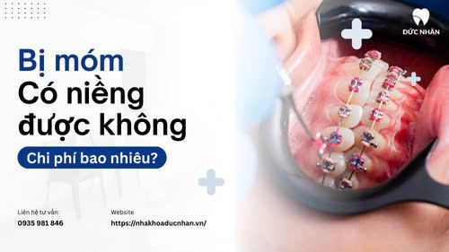 Bị móm có niềng răng được không? Chi phí bao nhiêu?